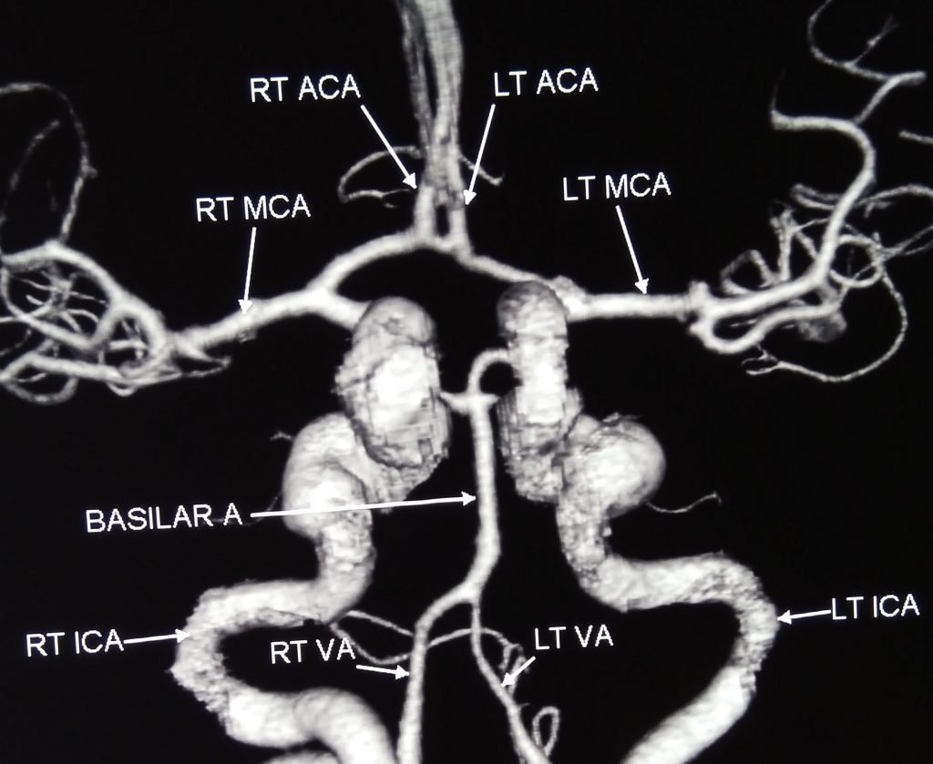 VI nerve Palsy - clinical image 2 of 6