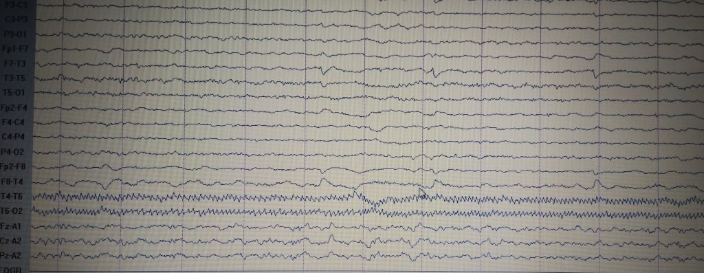 Tinnitus - clinical image 1 of 2