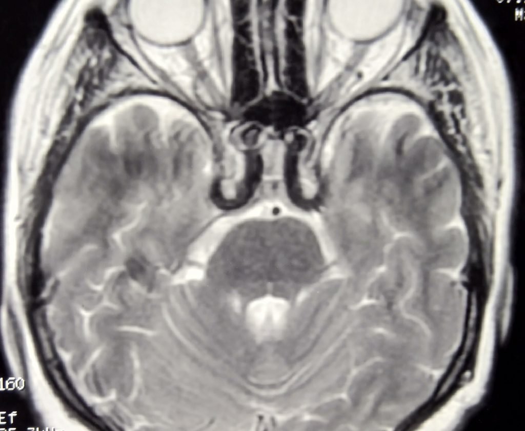 VI nerve Palsy - clinical image 1 of 6