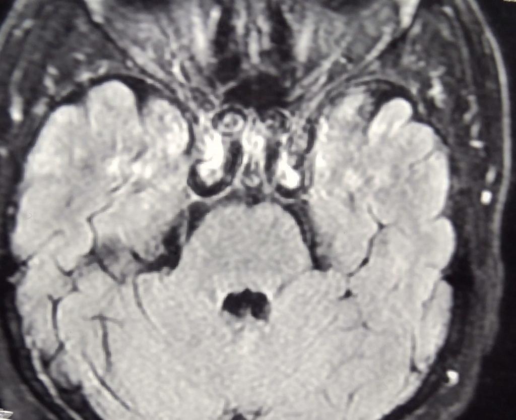 VI nerve Palsy - clinical image 4 of 6