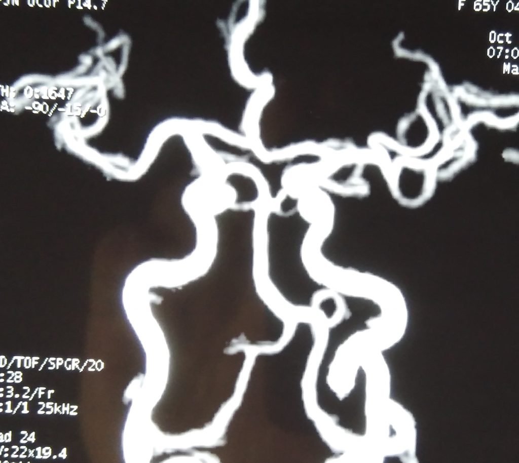 Arterial Loops - clinical image 1 of 3