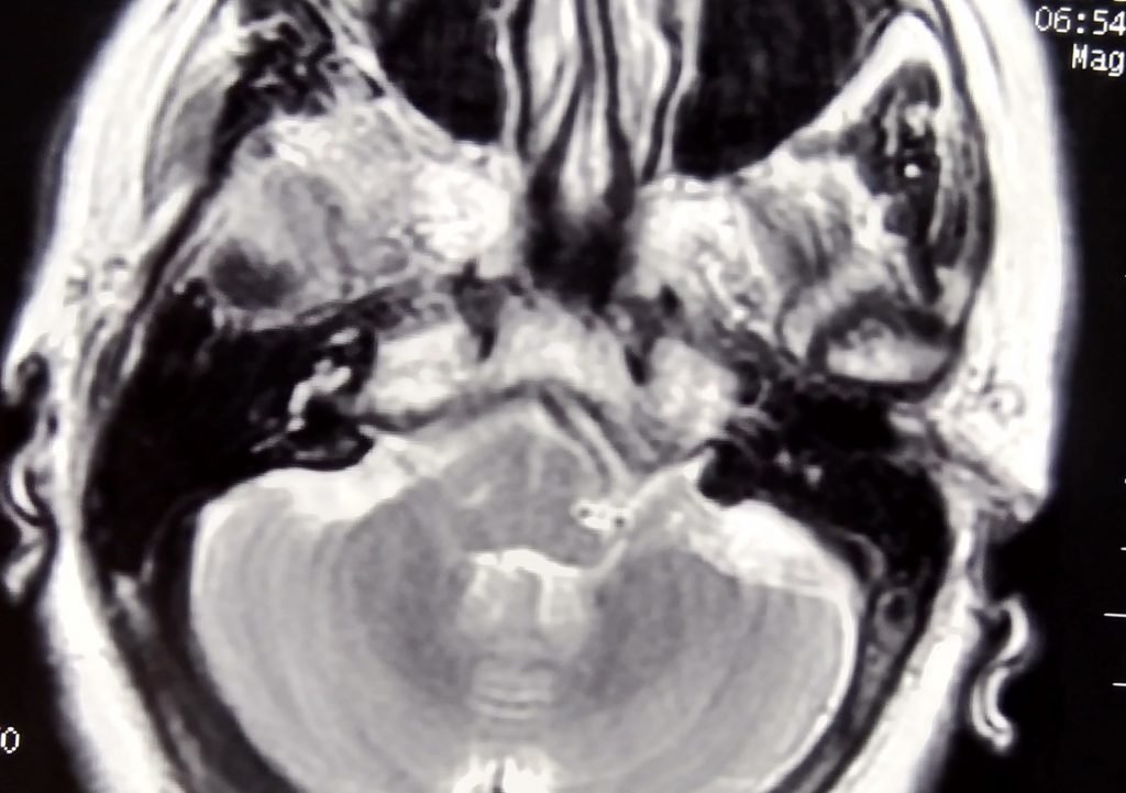Arterial Loops - clinical image 2 of 3
