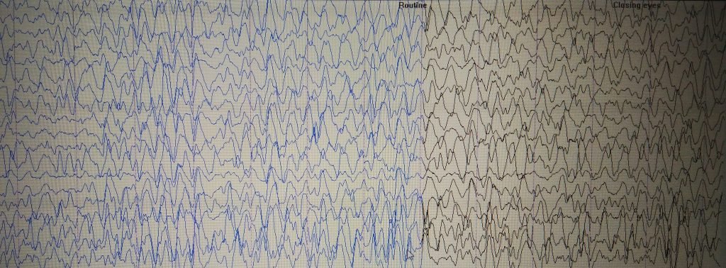 Ictal Vomiting - clinical image 4 of 5