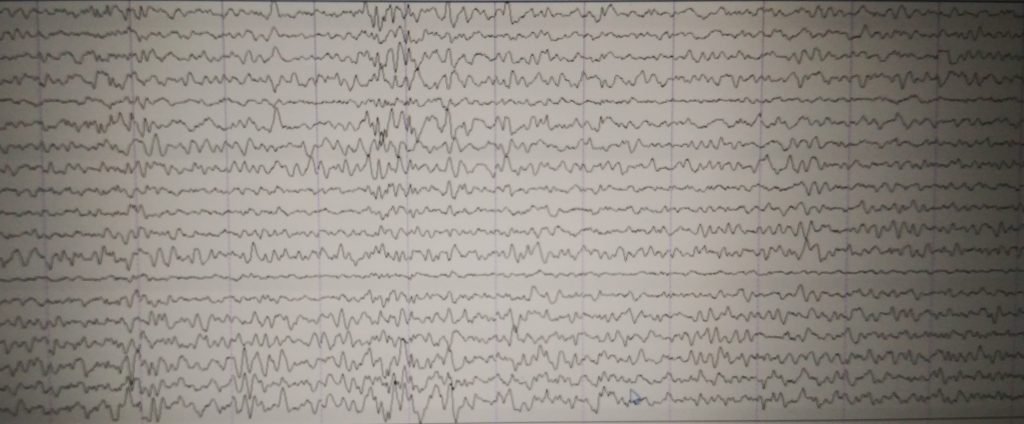 Ictal Vomiting - clinical image 5 of 5