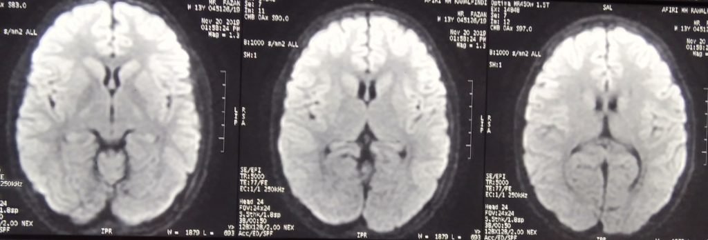 Ictal Vomiting - clinical image 3 of 5