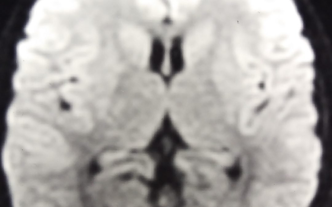 Ictal Vomiting - clinical image 2 of 5