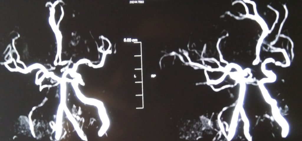 CNS Vasculitis - clinical image 3 of 5