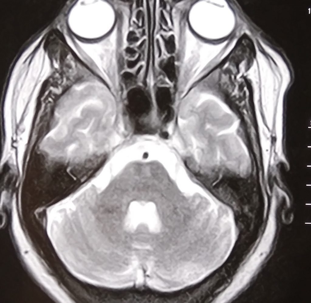 CNS Vasculitis - clinical image 1 of 5