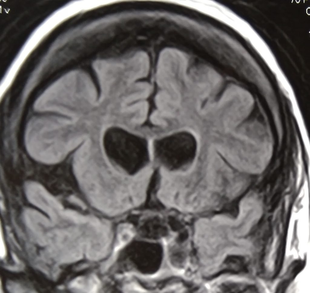 CNS Vasculitis - clinical image 2 of 5