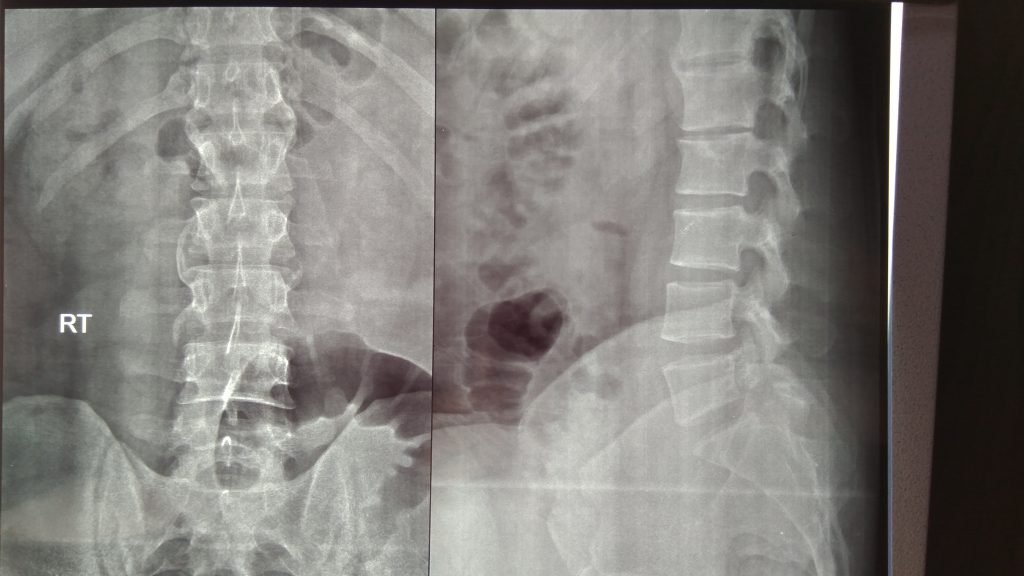 TNF inhibitor in AS - clinical image 1 of 2