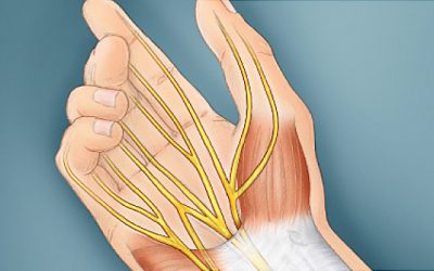 CARPAL TUNNEL SYNDROME